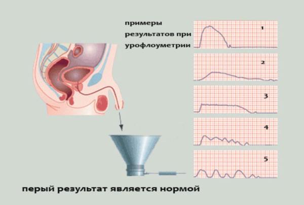 Урофлоуметрия